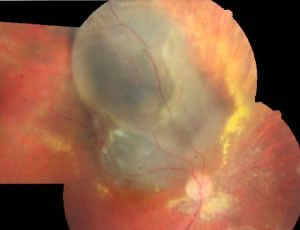 choroidal melanoma