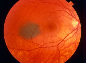 choroidal nevus