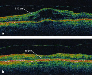 Cystoid Macular Edema