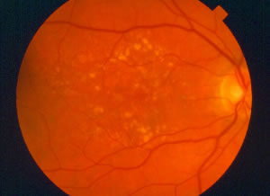 dry amd