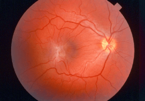 epiretinal_membrane