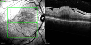 epiretinal_membrane_2