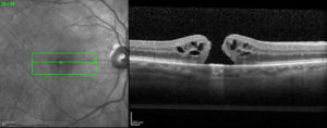 macular_hole