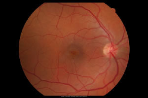 macular_hole