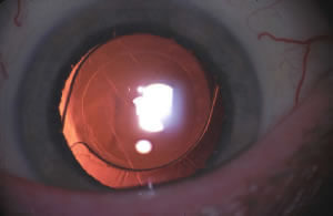 implant