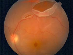 retinal detachment 2