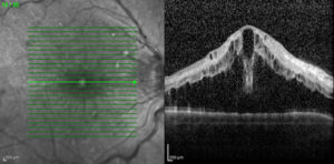 retinal_vein_occlusion_4