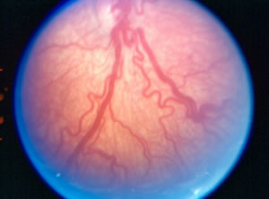 Retinopathy of Prematurity (ROP) Treatment