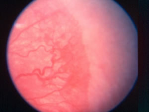 Retinopathy Of Prematurity (ROP)